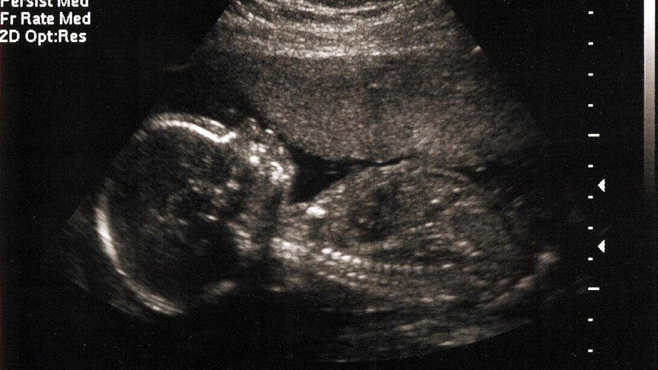 Un Bebé sobrevive en cavidad abdominal de madre tras aborto fallido